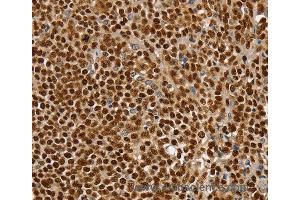Immunohistochemistry of Human ovarian cancer using SSB Polyclonal Antibody at dilution of 1:30 (SSB antibody)