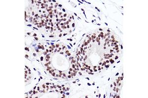 Immunohistochemistry of paraffin-embedded human breast cancer using MonoMethyl-Histone H3-K18 Rabbit mAb (ABIN7267683) at dilution of 1:100 (40x lens). (Histone 3 antibody  (H3K18me))