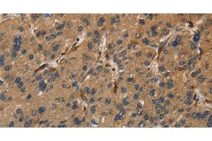 Immunohistochemistry of paraffin-embedded Human liver cancer tissue using UBE2S Polyclonal Antibody at dilution 1:40 (UBE2S antibody)