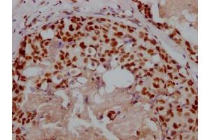 IHC image of ABIN7127596 diluted at 1:100 and staining in paraffin-embedded human breast cancer performed on a Leica BondTM system. (Recombinant XRCC5 antibody)