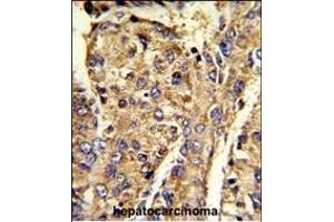 Formalin-fixed and paraffin-embedded human hepatocarcinoma reacted with HNRPL Antibody (C-term), which was peroxidase-conjugated to the secondary antibody, followed by DAB staining.