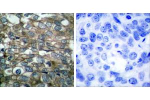 Peptide - +Immunohistochemical analysis of paraffin-embedded human breast carcinoma tissue using EGFR (Ab-869) antibody (#B7065). (EGFR antibody  (Tyr869))