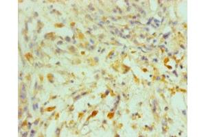 Immunohistochemistry of paraffin-embedded human melanoma using ABIN7164069 at dilution of 1:100