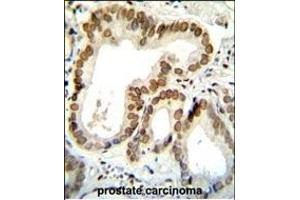 BTG2 Antibody (N-term) (ABIN654080 and ABIN2843972) immunohistochemistry analysis in formalin fixed and paraffin embedded human prostate carcinoma followed by peroxidase conjugation of the secondary antibody and DAB staining.