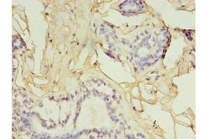 Immunohistochemistry of paraffin-embedded human breast cancer using ABIN7153819 at dilution of 1:100 (GGPS1 antibody  (AA 1-300))