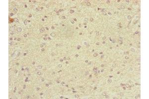 Immunohistochemistry of paraffin-embedded human glioma using ABIN7149326 at dilution of 1:100 (DYNC2LI1 antibody  (AA 1-352))