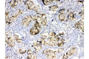 IHC testing of FFPE human breast cancer tissue with GALE antibody at 1ug/ml.