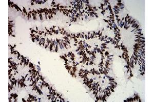 Immunohistochemical analysis of paraffin-embedded colon cancer tissues using ESR1 mouse mAb with DAB staining. (Estrogen Receptor alpha antibody  (AA 2-185))