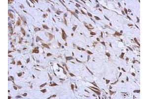 IHC-P Image Immunohistochemical analysis of paraffin-embedded human hepatoma, using MMACHC, antibody at 1:500 dilution.