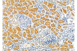 ABIN6260014 and ABIN6279139 at 1/100 staining Human kidney cancer and adjacent normal tissues by IHC-P. (AQP9 antibody  (Internal Region))
