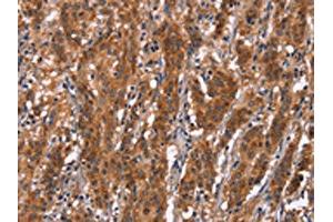 The image on the left is immunohistochemistry of paraffin-embedded Human gastric cancer tissue using ABIN7190842(GPHN Antibody) at dilution 1/30, on the right is treated with synthetic peptide.