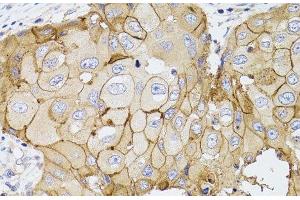 Immunohistochemistry of paraffin-embedded Human breast cancer using PDE4D Polyclonal Antibody at dilution of 1:100 (40x lens). (PDE4D antibody)