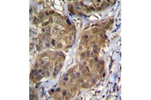 Formalin fixed, paraffin embedded human breast carcinoma stained with RNF11 Antibody (Center) followed by peroxidase conjugation of the secondary antibody and DAB staining (RNF11 antibody  (Middle Region))