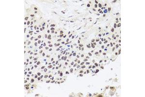 Immunohistochemistry of paraffin-embedded human lung cancer using RPP30 antibody (ABIN5974603) at dilution of 1/100 (40x lens).