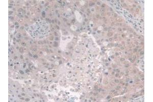 IHC-P analysis of Human Breast Cancer Tissue, with DAB staining. (NCOA3 antibody  (AA 1023-1304))