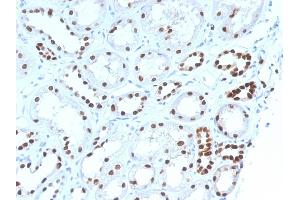 Formalin-fixed, paraffin-embedded human Renal Cell Carcinoma stained with PAX8 Mouse Monoclonal Antibody (PAX8/1492). (PAX8 antibody  (AA 60-261))