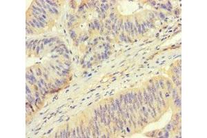 Immunohistochemistry of paraffin-embedded human colon cancer using ABIN7168424 at dilution of 1:100 (ROPN1 antibody  (AA 1-212))