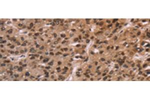 Immunohistochemistry of paraffin-embedded Human liver cancer tissue using LMNB1 Polyclonal Antibody at dilution of 1:60(x200) (Lamin B1 antibody)