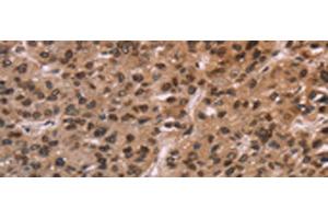 Immunohistochemistry of paraffin-embedded Human liver cancer tissue using LMNB1 Polyclonal Antibody at dilution of 1:60(x200)