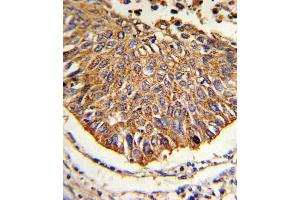 Formalin-fixed and paraffin-embedded human lung carcinoma reacted with MDH2 Antibody (Center), which was peroxidase-conjugated to the secondary antibody, followed by DAB staining. (MDH2 antibody  (AA 86-115))