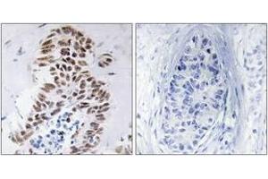 Immunohistochemistry analysis of paraffin-embedded human lung carcinoma tissue, using DAPK3 (Ab-265) Antibody.