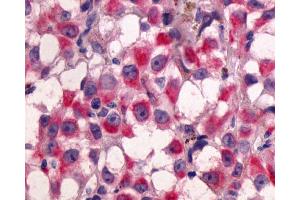 Anti-GPR64 antibody IHC of human Skin, Melanoma. (Adhesion G-Protein Coupled Receptor G2 (ADGRG2) (C-Term) antibody)