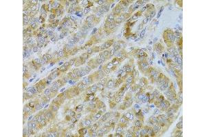 Immunohistochemistry of paraffin-embedded Human thyroid cancer using DLD Polyclonal Antibody at dilution of 1:100 (40x lens).