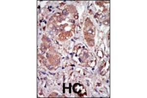 Formalin-fixed and paraffin-embedded human cancer tissue reacted with the primary antibody, which was peroxidase-conjugated to the secondary antibody, followed by DAB staining. (EIF2AK2 antibody  (C-Term))