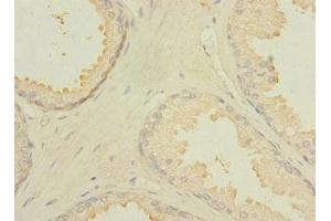 Immunohistochemistry of paraffin-embedded human prostate cancer using ABIN7174924 at dilution of 1:100 (CXorf21 antibody  (AA 1-301))