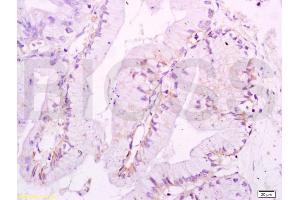 Formalin-fixed and paraffin embedded human endometrium carcinoma labeled with Anti-Ezrin Polyclonal Antibody, Unconjugated (ABIN675234) at 1:200 followed by conjugation to the secondary antibody and DAB staining. (Ezrin antibody  (AA 455-586))