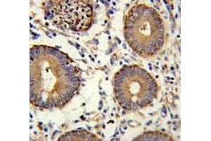 CEA antibody immunohistochemistry analysis in formalin fixed and paraffin embedded human colon carcinoma. (CEA antibody  (AA 400-429))