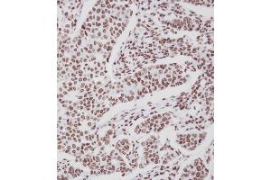 Immunohistochemical analysis of A on paraffin-embedded Human breast carcinoma tissue. (ERBB4 antibody  (pTyr1188))