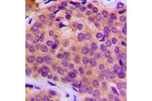 Immunohistochemical analysis of MMP3 staining in human breast cancer formalin fixed paraffin embedded tissue section.