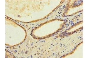 Immunohistochemistry of paraffin-embedded human prostate cancer using ABIN7173179 at dilution of 1:100 (TMEM255B antibody  (AA 221-356))