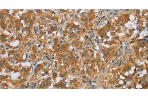 Immunohistochemistry of paraffin-embedded Human thyroid cancer tissue using FOXB1 Polyclonal Antibody at dilution 1:30