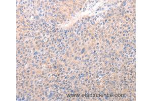 Immunohistochemistry of Human lung cancer using ACO1 Polyclonal Antibody at dilution of 1:50 (Aconitase 1 antibody)