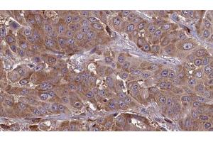 ABIN6273643 at 1/100 staining Human liver cancer tissue by IHC-P. (IFITM1 antibody  (N-Term))
