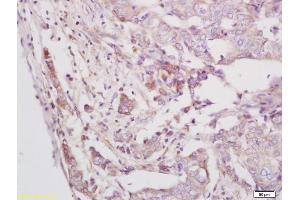 Formalin-fixed and paraffin embedded human breast carcinoma labeled with Anti-Phospho-BMX/ETK (Tyr556) Polyclonal Antibody, Unconjugated (ABIN756667) at 1:200 followed by conjugation to the secondary antibody and DAB staining (BMX antibody  (pTyr566))