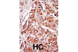 Formalin-fixed and paraffin-embedded human hepatocellular carcinoma tissue reacted with EIF2AK2 polyclonal antibody  , which was peroxidase-conjugated to the secondary antibody, followed by DAB staining. (EIF2AK2 antibody  (N-Term))