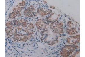 IHC-P analysis of Human Lung Cancer Tissue, with DAB staining. (AKT2 antibody  (AA 142-412))