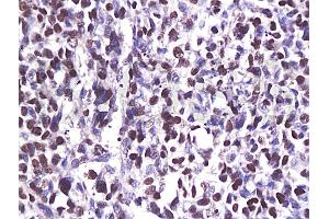 Formalin-fixed and paraffin embedded human breast carcinoma labeled with Anti-CDK6 Polyclonal Antibody (ABIN670236), Unconjugated at 1:200, followed by conjugation to the secondary antibody and DAB staining