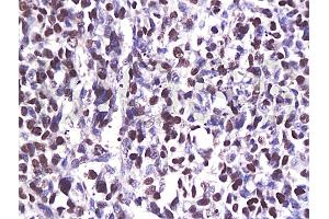 Formalin-fixed and paraffin embedded human breast carcinoma labeled with Anti-CDK6 Polyclonal Antibody (ABIN670236), Unconjugated at 1:200, followed by conjugation to the secondary antibody and DAB staining (CDK6 antibody  (AA 21-110))
