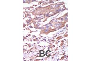 Formalin-fixed and paraffin-embedded human cancer tissue reacted with CAMK2A polyclonal antibody  , which was peroxidase-conjugated to the secondary antibody, followed by AEC staining. (CAMK2A antibody  (C-Term))