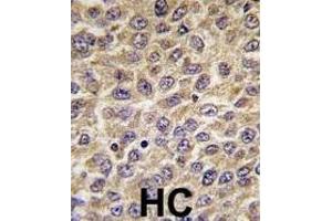 Formalin-fixed and paraffin-embedded human hepatocarcinoma tissue reacted with ILK Antibody  (ABIN391996 and ABIN2841782) , which was peroxidase-conjugated to the secondary antibody, followed by DAB staining. (ILK antibody  (AA 225-253))