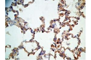 Rat lung cancer tissue stained by Rabbit Anti-CRAMP (Mouse) Antibody (Cathelicidin antibody  (AA 140-173))