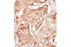 Formalin-fixed and paraffin-embedded human cancer tissue reacted with the primary antibody, which was peroxidase-conjugated to the secondary antibody, followed by DAB staining. (CDK18 antibody  (N-Term))