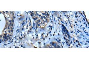 Immunohistochemistry of paraffin-embedded Human cervical cancer tissue using UFC1 Polyclonal Antibody at dilution of 1:50(x200) (UFC1 antibody)