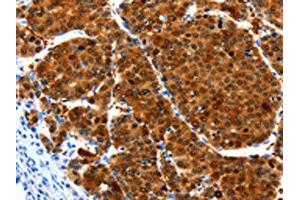 The image on the left is immunohistochemistry of paraffin-embedded Human liver cancer tissue using ABIN7190937(HIBADH Antibody) at dilution 1/25, on the right is treated with synthetic peptide. (HIBADH antibody)