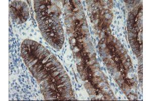 Immunohistochemical staining of paraffin-embedded Adenocarcinoma of Human endometrium tissue using anti-FOLH1 mouse monoclonal antibody. (PSMA antibody)
