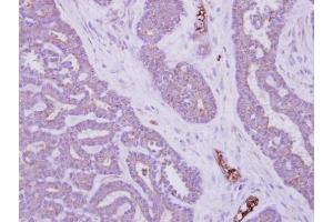 IHC-P Image Immunohistochemical analysis of paraffin-embedded human colon carcinoma, using MTMR14, antibody at 1:500 dilution. (MTMR14 antibody)